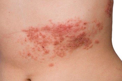Một số bệnh da do virus thường gặp - Ảnh 1. Một số bệnh da do virus thường gặp - Ảnh 1.