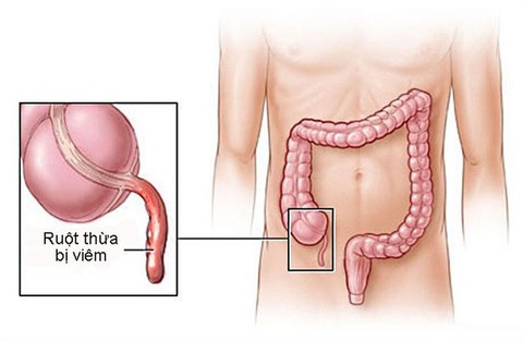 Những điều cần biết về viêm ruột thừa - Ảnh 1. Những điều cần biết về viêm ruột thừa - Ảnh 1.