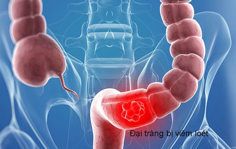 Phòng bệnh viêm đại tràng - Ảnh 1. Phòng bệnh viêm đại tràng - Ảnh 1.
