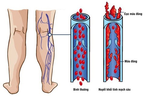 Những điều cần biết về bệnh huyết khối tĩnh mạch sâu - Ảnh 1. Những điều cần biết về bệnh huyết khối tĩnh mạch sâu - Ảnh 1.
