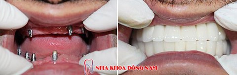 Kỹ thuật cấy ghép răng giả cùng lúc nhổ răng thật - Ảnh 5. Kỹ thuật cấy ghép răng giả cùng lúc nhổ răng thật - Ảnh 5.