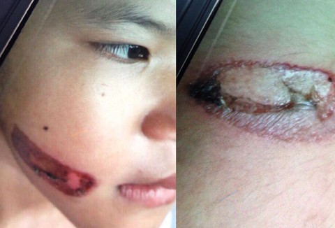 Cách ly ngay bé gái 7 tuổi nghi bị dí sắt nung khỏi cha ruột - Ảnh 2. Cách ly ngay bé gái 7 tuổi nghi bị dí sắt nung khỏi cha ruột - Ảnh 2.