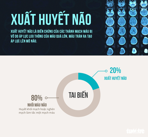 Xuất huyết não khởi điểm từ đâu? - Ảnh 1. Xuất huyết não khởi điểm từ đâu? - Ảnh 1.