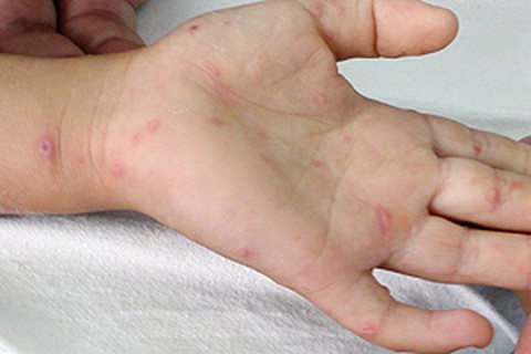 Chăm sóc và điều trị bệnh tay - chân - miệng ở trẻ - Ảnh 1. Chăm sóc và điều trị bệnh tay - chân - miệng ở trẻ - Ảnh 1.