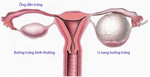 U nang buồng trứng - Ảnh 1. U nang buồng trứng - Ảnh 1.