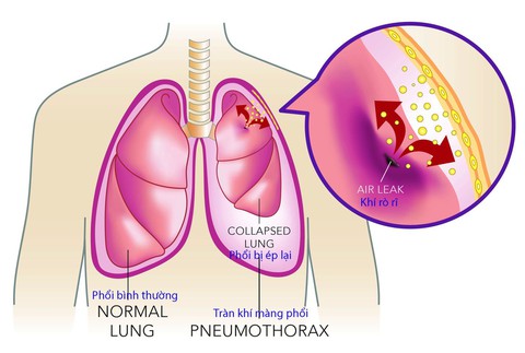 Tràn khí màng phổi tự phát - Ảnh 1. Tràn khí màng phổi tự phát - Ảnh 1.