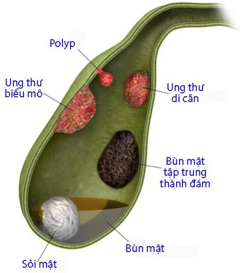 Chẩn đoán và xử trí polyp túi mật - Ảnh 1. Chẩn đoán và xử trí polyp túi mật - Ảnh 1.