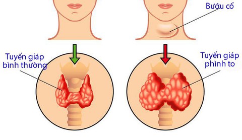 Bệnh bướu cổ có nên mổ? - Ảnh 1. Bệnh bướu cổ có nên mổ? - Ảnh 1.