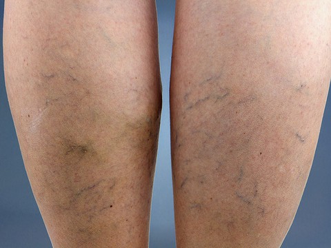 Điều trị giãn tĩnh mạch nông, suy tĩnh mạch mạn tính - Ảnh 1. Điều trị giãn tĩnh mạch nông, suy tĩnh mạch mạn tính - Ảnh 1.