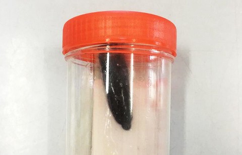 Con đỉa 5cm sống hai tháng trong đường thở bé gái - Ảnh 1. Con đỉa 5cm sống hai tháng trong đường thở bé gái - Ảnh 1.