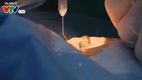 Gia tăng số lượng người cần ghép giác mạc mỗi năm - Ảnh 1. Gia tăng số lượng người cần ghép giác mạc mỗi năm - Ảnh 1.