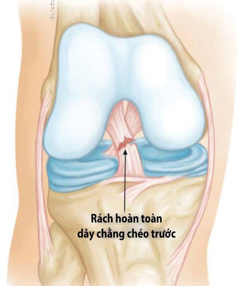 Chấn thương dây chằng chéo trước - Ảnh 1. Chấn thương dây chằng chéo trước - Ảnh 1.