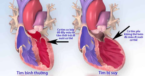 Những cách để phòng tránh suy tim - Ảnh 1. Những cách để phòng tránh suy tim - Ảnh 1.