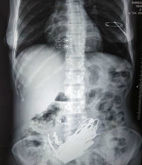 1,5kg bulong, ốc vít, sợi khóa, kẹp tóc... trong dạ dày - Ảnh 1. 1,5kg bulong, ốc vít, sợi khóa, kẹp tóc... trong dạ dày - Ảnh 1.