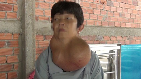 Cắt thành công bướu cổ nặng gần 5kg cho một phụ nữ - Ảnh 1. Cắt thành công bướu cổ nặng gần 5kg cho một phụ nữ - Ảnh 1.