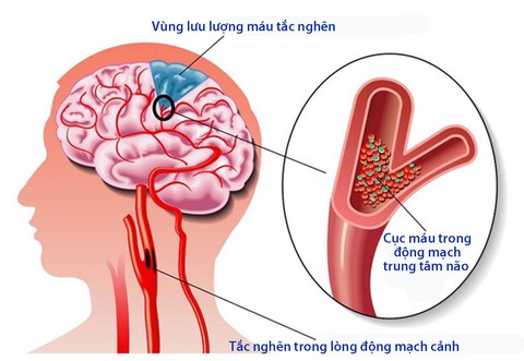 Không nên chủ quan với bệnh tai biến mạch máu não nhẹ - Ảnh 1. Không nên chủ quan với bệnh tai biến mạch máu não nhẹ - Ảnh 1.