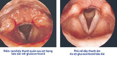 Tổn thương thanh quản do glucocorticoid xịt họng - Ảnh 1. Tổn thương thanh quản do glucocorticoid xịt họng - Ảnh 1.