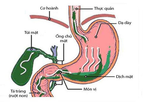 Trào ngược dịch mật - Ảnh 1. Trào ngược dịch mật - Ảnh 1.