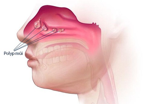 Polyp mũi - Nguyên nhân và cách điều trị - Ảnh 1. Polyp mũi - Nguyên nhân và cách điều trị - Ảnh 1.