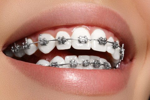 Niềng răng – một cách làm đẹp - Ảnh 1. Niềng răng – một cách làm đẹp - Ảnh 1.