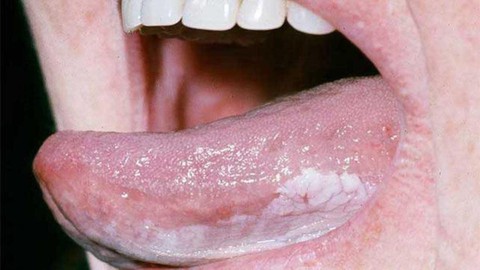 Ung thư lưỡi - Ảnh 1. Ung thư lưỡi - Ảnh 1.
