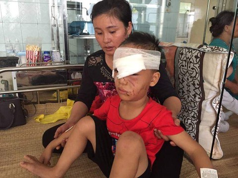 Thanh Hóa: 1 tuần 3 trẻ nhập viện do bị chó nhà nuôi cắn - Ảnh 1. Thanh Hóa: 1 tuần 3 trẻ nhập viện do bị chó nhà nuôi cắn - Ảnh 1.
