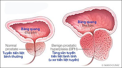 Những triệu chứng u xơ tiền liệt tuyến thường gặp - Ảnh 1. Những triệu chứng u xơ tiền liệt tuyến thường gặp - Ảnh 1.