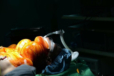 Nữ bệnh nhân 10 năm mang bướu to vượt mặt - Ảnh 1. Nữ bệnh nhân 10 năm mang bướu to vượt mặt - Ảnh 1.