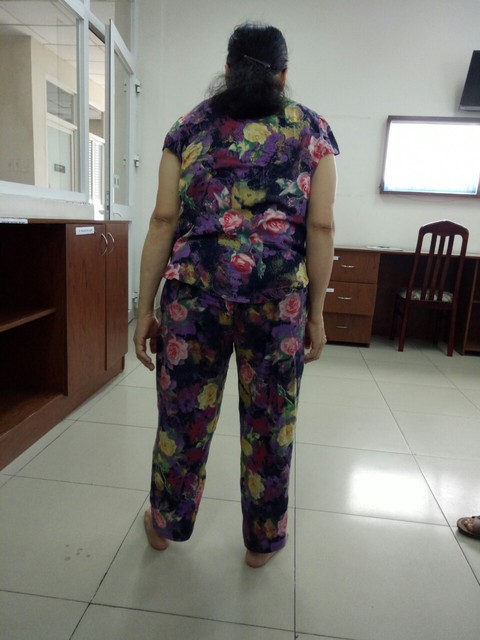 Thay hai khớp háng giúp người viêm cột sống dính khớp đi lại - Ảnh 4. Thay hai khớp háng giúp người viêm cột sống dính khớp đi lại - Ảnh 4.