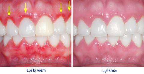 Nguyên nhân gây bệnh viêm lợi và cách điều trị - Ảnh 1. Nguyên nhân gây bệnh viêm lợi và cách điều trị - Ảnh 1.