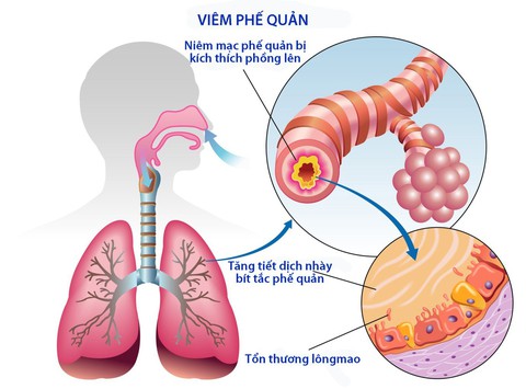 Viêm phế quản cấp ở người lớn - Ảnh 1. Viêm phế quản cấp ở người lớn - Ảnh 1.