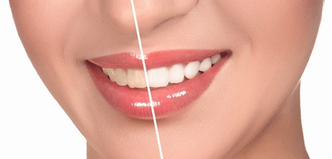 Nên tẩy trắng răng tại nhà hay phòng khám nha khoa? - Ảnh 2. Nên tẩy trắng răng tại nhà hay phòng khám nha khoa? - Ảnh 2.