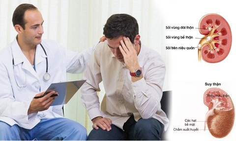 Mối liên quan chặt chẽ giữa sỏi thận và suy thận - Ảnh 1. Mối liên quan chặt chẽ giữa sỏi thận và suy thận - Ảnh 1.
