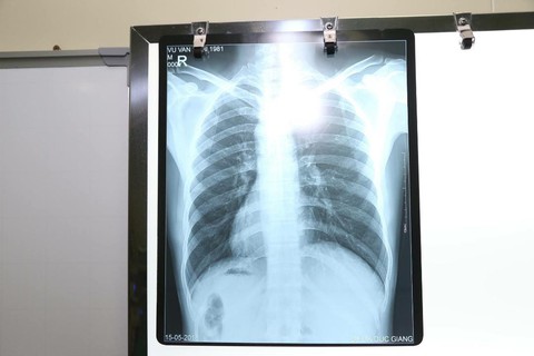 Nam bệnh nhân phủ tạng đảo ngược ở Hà Nội: tim bên phải, gan bên trái - Ảnh 1. Nam bệnh nhân phủ tạng đảo ngược ở Hà Nội: tim bên phải, gan bên trái - Ảnh 1.