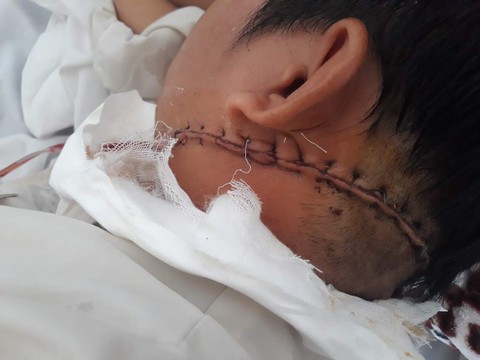 Cứu sống nạn nhân bị mã tấu chém đứt tĩnh mạch cổ - Ảnh 1. Cứu sống nạn nhân bị mã tấu chém đứt tĩnh mạch cổ - Ảnh 1.