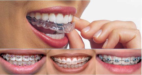 Niềng răng không mắc cài có ưu điểm gì? - Ảnh 2. Niềng răng không mắc cài có ưu điểm gì? - Ảnh 2.