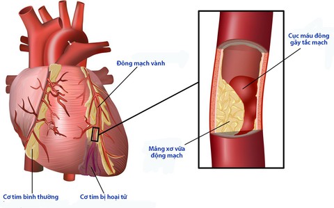 Biến chứng tim mạch của bệnh đái tháo đường - Ảnh 1. Biến chứng tim mạch của bệnh đái tháo đường - Ảnh 1.