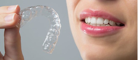 Niềng răng không mắc cài có ưu điểm gì? - Ảnh 3. Niềng răng không mắc cài có ưu điểm gì? - Ảnh 3.