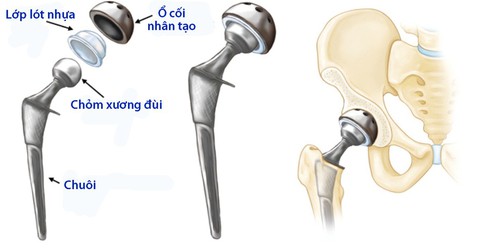 Thay khớp háng toàn phần - Ảnh 1. Thay khớp háng toàn phần - Ảnh 1.