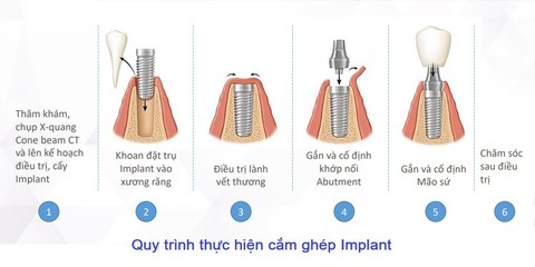 Loại trụ Implant nào tốt, “tuổi thọ” bao lâu? - Ảnh 4. Loại trụ Implant nào tốt, “tuổi thọ” bao lâu? - Ảnh 4.