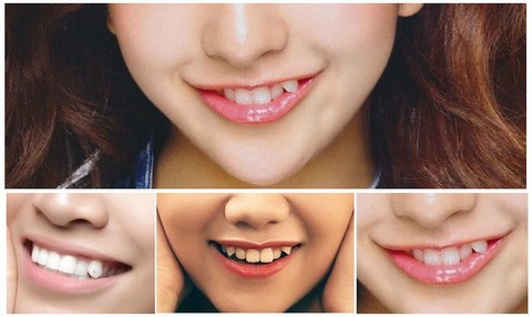 Làm răng khểnh thẩm mỹ để nụ cười thêm xinh được không? - Ảnh 2. Làm răng khểnh thẩm mỹ để nụ cười thêm xinh được không? - Ảnh 2.