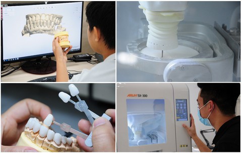 Khắc phục nhanh chóng và hiệu quả răng sứ bị hở - Ảnh 3. Khắc phục nhanh chóng và hiệu quả răng sứ bị hở - Ảnh 3.