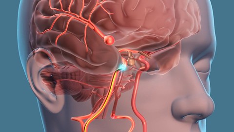 Phình mạch não – Kẻ giết người thầm lặng - Ảnh 1. Phình mạch não – Kẻ giết người thầm lặng - Ảnh 1.
