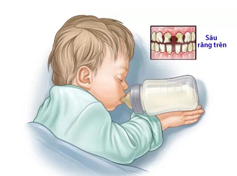 Phòng ngừa hội chứng sâu răng do bú bình - Ảnh 1. Phòng ngừa hội chứng sâu răng do bú bình - Ảnh 1.