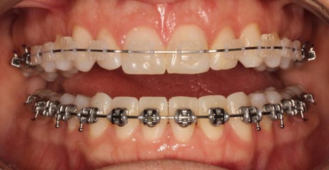 Niềng răng để khỏe, đẹp hơn - Ảnh 5. Niềng răng để khỏe, đẹp hơn - Ảnh 5.