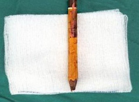 Bạn nghịch dại, một học sinh bị bút chì đâm vào mông 8cm - Ảnh 1. Bạn nghịch dại, một học sinh bị bút chì đâm vào mông 8cm - Ảnh 1.