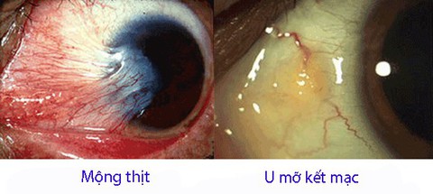 U mỡ kết mạc và mộng thịt (màng mắt) - Ảnh 1. U mỡ kết mạc và mộng thịt (màng mắt) - Ảnh 1.