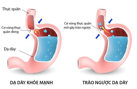 Cẩn thận với bệnh trào ngược dạ dày, thực quản - Ảnh 1. Cẩn thận với bệnh trào ngược dạ dày, thực quản - Ảnh 1.