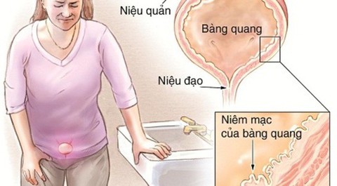 Viêm bàng quang tái lại nhiều lần - Ảnh 1. Viêm bàng quang tái lại nhiều lần - Ảnh 1.