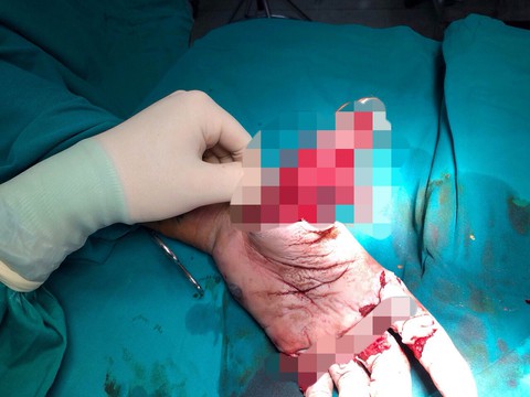 Dập nát bàn tay do đốt pháo - Ảnh 1. Dập nát bàn tay do đốt pháo - Ảnh 1.